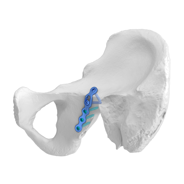 Flexible Acetabular Plate (FAP) System Iliosciatic Anatomic Locking Plate