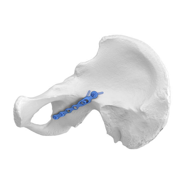 Flexible Acetabular Plate (FAP) System Iliosciatic Anatomic Locking Plate, oblique