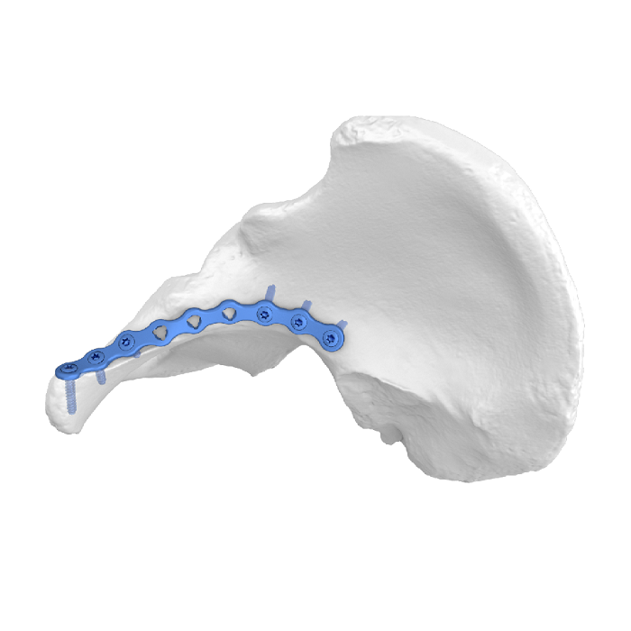 Flexible Acetabular Plate (FAP) System Iliopubic Anterior Line Anatomic Locking Plate