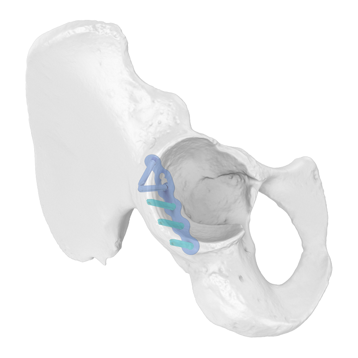 Flexible Acetabular Plate (FAP) System Iliosciatic Anatomic Locking Plate