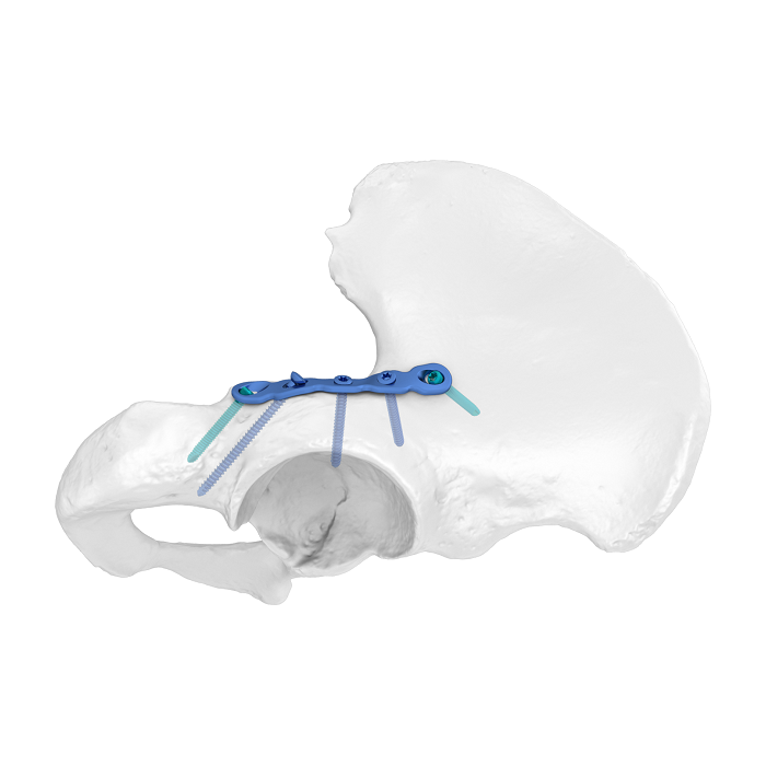 Flexible Acetabular Plate (FAP) System Posterior Column Anatomic Locking Plate