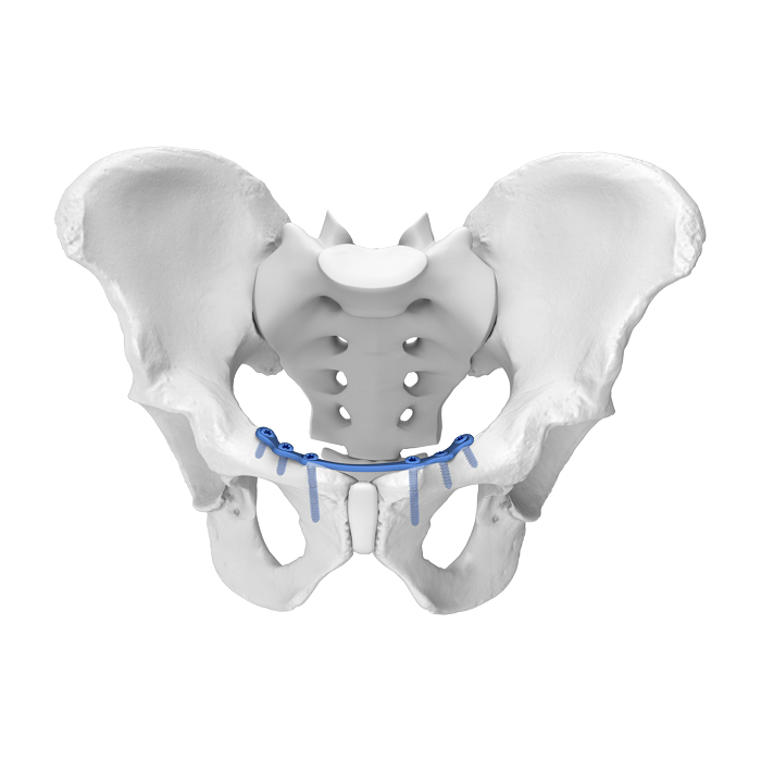 Flexible Acetabular Plate (FAP) System Symphysis Pubis Medial Anatomic Locking Plate