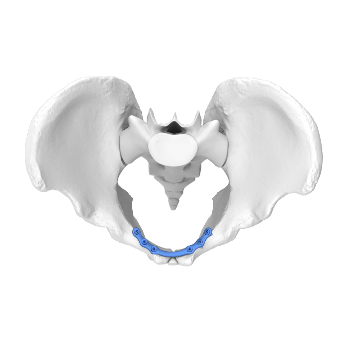 Flexible Acetabular Plate (FAP) System Symphysis Pubis Medial Anatomic Locking Plate