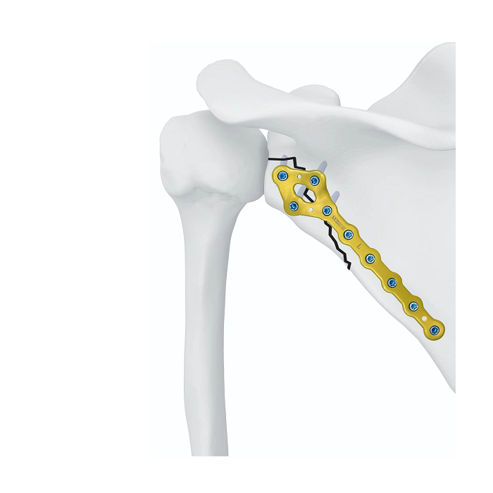 Scapula Lateral Locking Plate