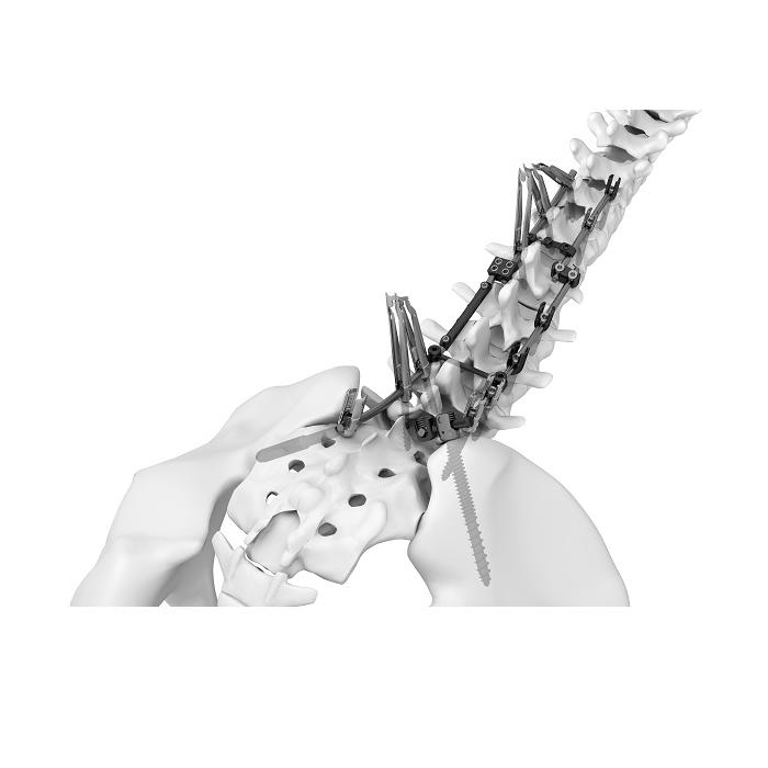 TINA Spine System