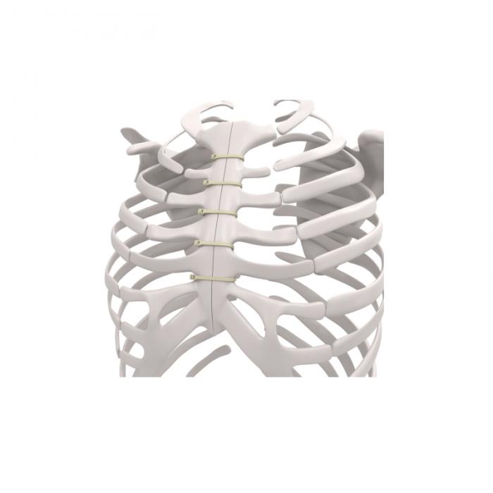 rib fixation system