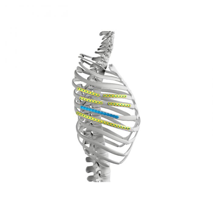 rib fixation system
