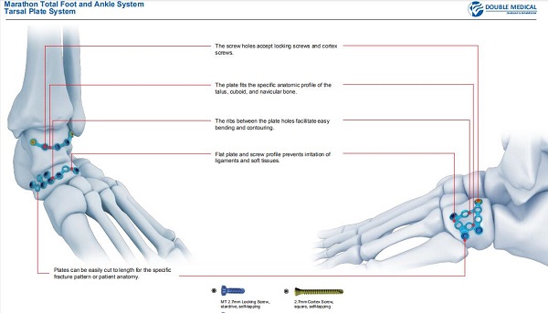 Series of orthopaedic knowledge introduction (Ⅲ)