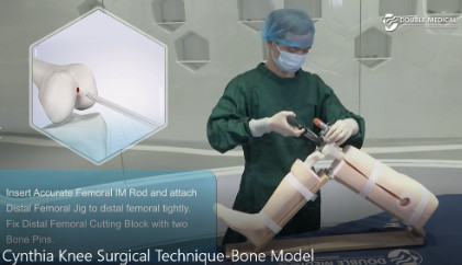 Double Medical Cynthia Knee Replacement Bone Model Demonstration 