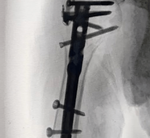 Case Sharing: The First Humeral Cup Ball Intramedullary Nail for Proximal Humeral Fracture in China