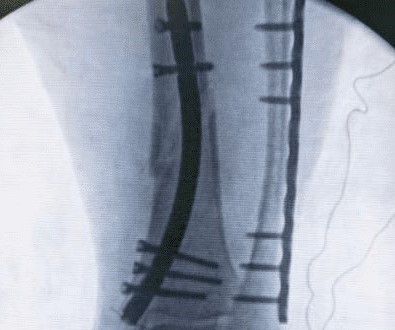 Case share: Fracture of the Distal Tibia