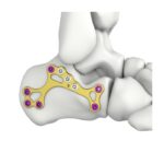 Itval Calcaneal MIS Locking Plate