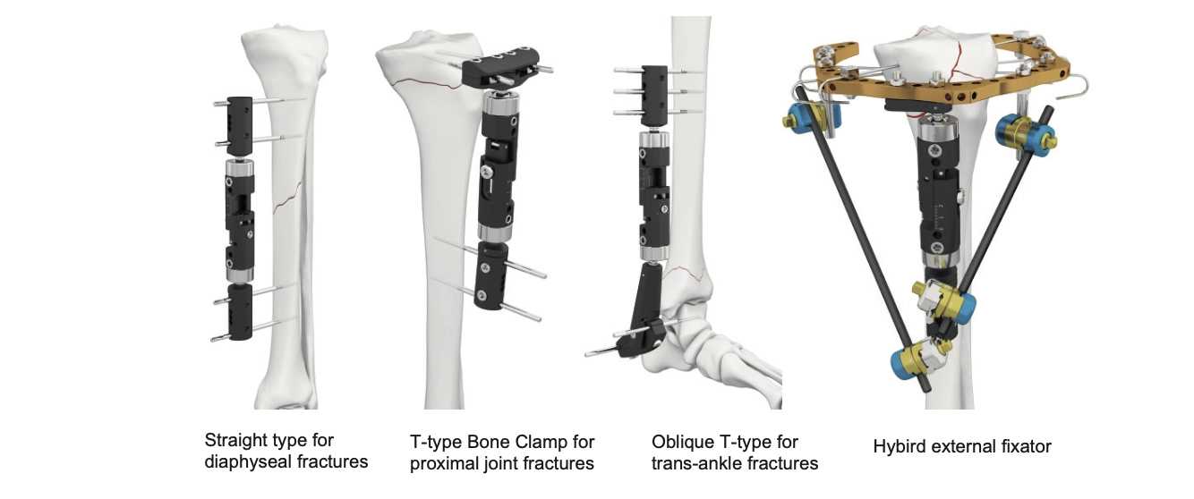 Dynamic External Fixator 1 This dynamic external fixator features cylindrical structure with universally‑rotatable bone screw clamps for easy pin insertion. Equipped with fine‑adjustment rods to enable early fracture‑end micromotion and accelerate bone healing. Multiple configurations are available to suit diaphyseal, peri‑articular, trans‑ankle and hybrid complex limb fractures.