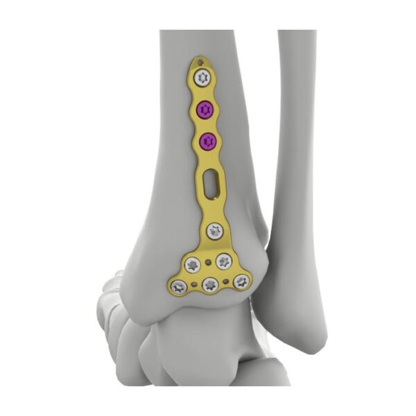 Itval Distal Posterior Tibial Locking Plate