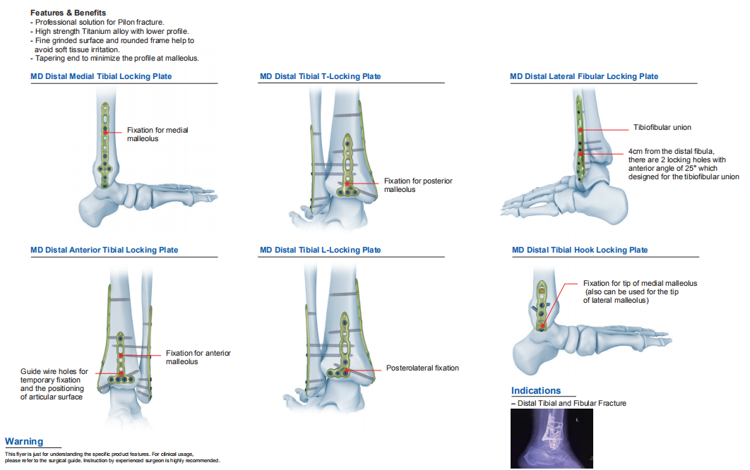 MD distal tibial T-kilitli plak, posterior malleol fiksasyonu için kullanılır.