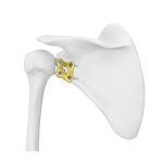 Glenoid Locking Plate