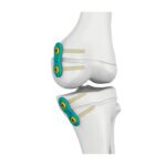 3.0/4.5mm Epiphyseal Plate