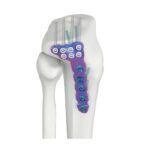VAL Proximal Lateral Tibial DR Locking Plate