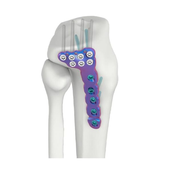 VAL Proximal Lateral Tibial DR Locking Plate