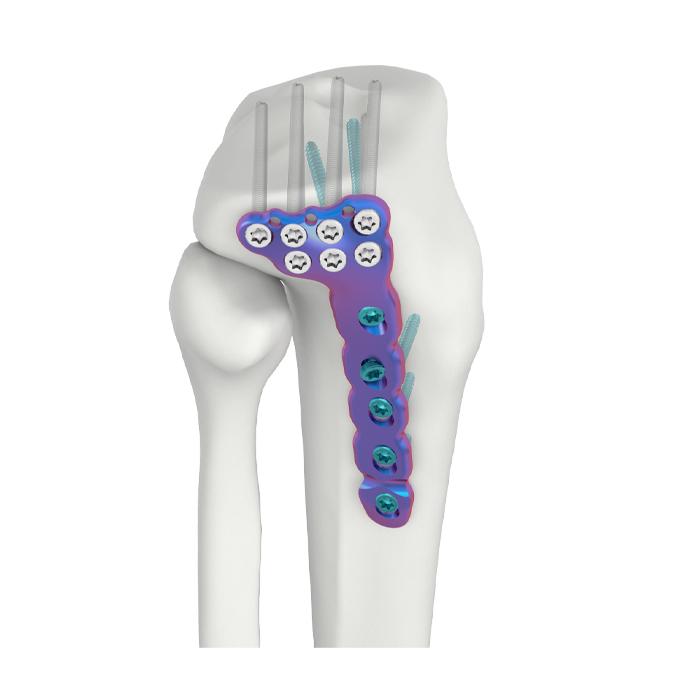 VAL Proximal Lateral Tibial DR Locking Plate