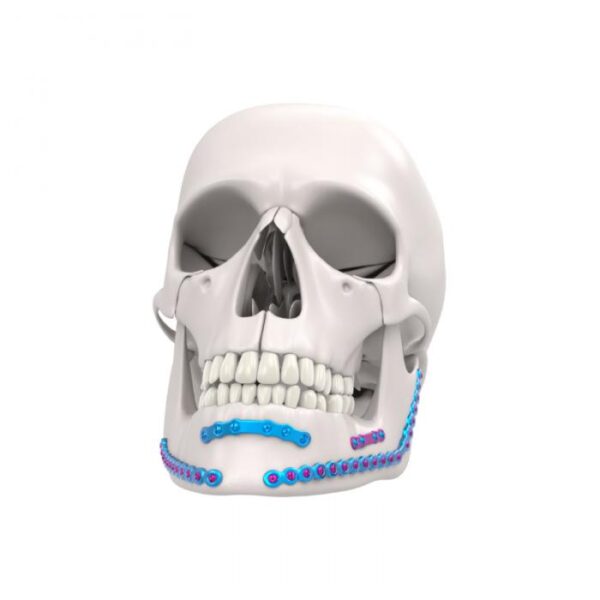 Mandible Fixation System
