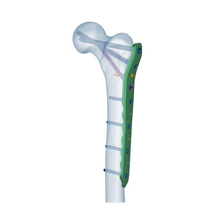 Proximal Femoral Locking Plate