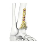 Itval Distal Anterior Tibial Locking Plate