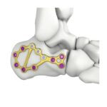 Itval Calcaneal Locking Plate
