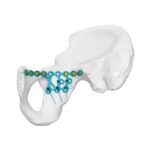 High Posterior Column Infra-arcuate Line Locking Plate