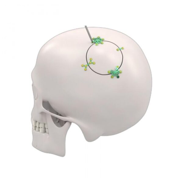 Cranio Fixation System