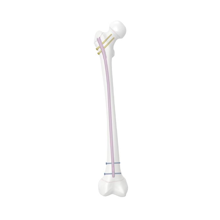 Adolescent femoral nail system