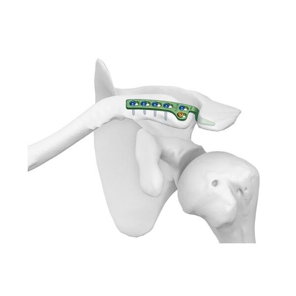 Clavicular Hook Locking Plate II