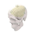 Personalized PEEK & Titanium Patient Specific Implant for Cranial Repair and Construction