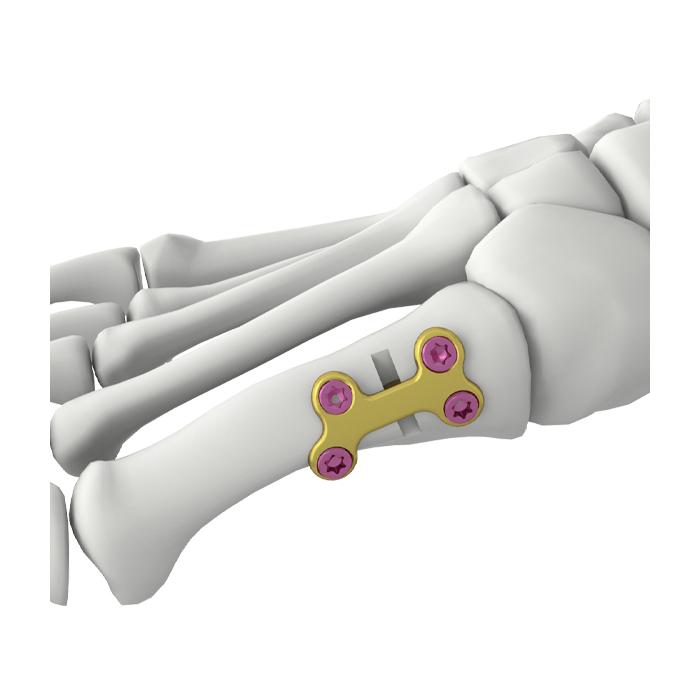 Itval First Metatarsal Osteotomy Locking Plate