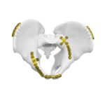 Posterior Surface Quadrangular Plate