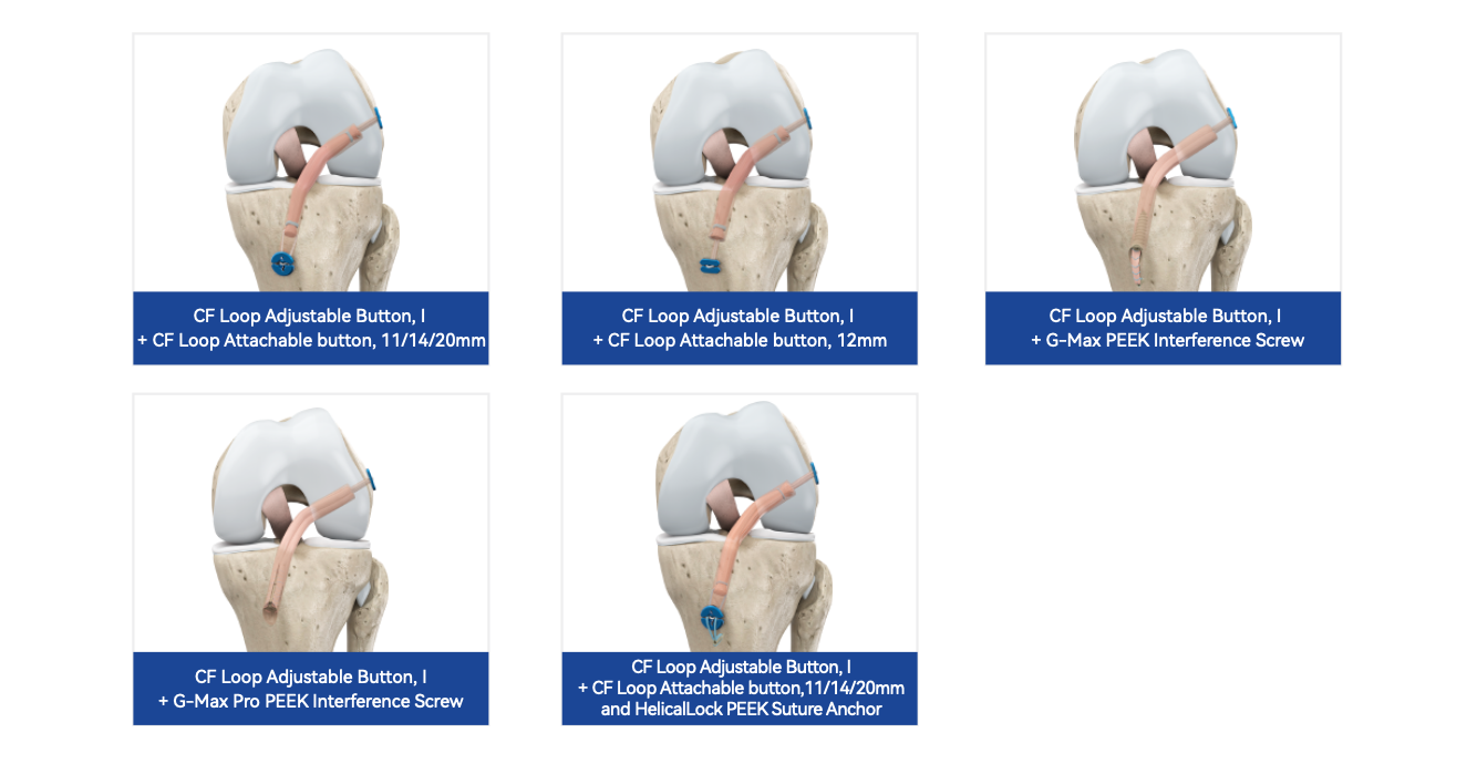 ACL Reconstruction Solution 6 The mini titanium plate with 3.4mm width can pass through the 3.5mm bone tunnel to retain more bone. And 4-holes design makes the loop inserted through the reserved hole intraoperatively to experience the sense of turning loop.