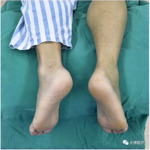 跟骨骨折是足部常见骨折之一，主要由外力创伤导致足跟部骨骼破坏，使其完整性或连续性中断。患者主要表现为剧烈疼痛、肿胀、瘀斑、足跟外翻畸形、扁平足、无法正常行走。.