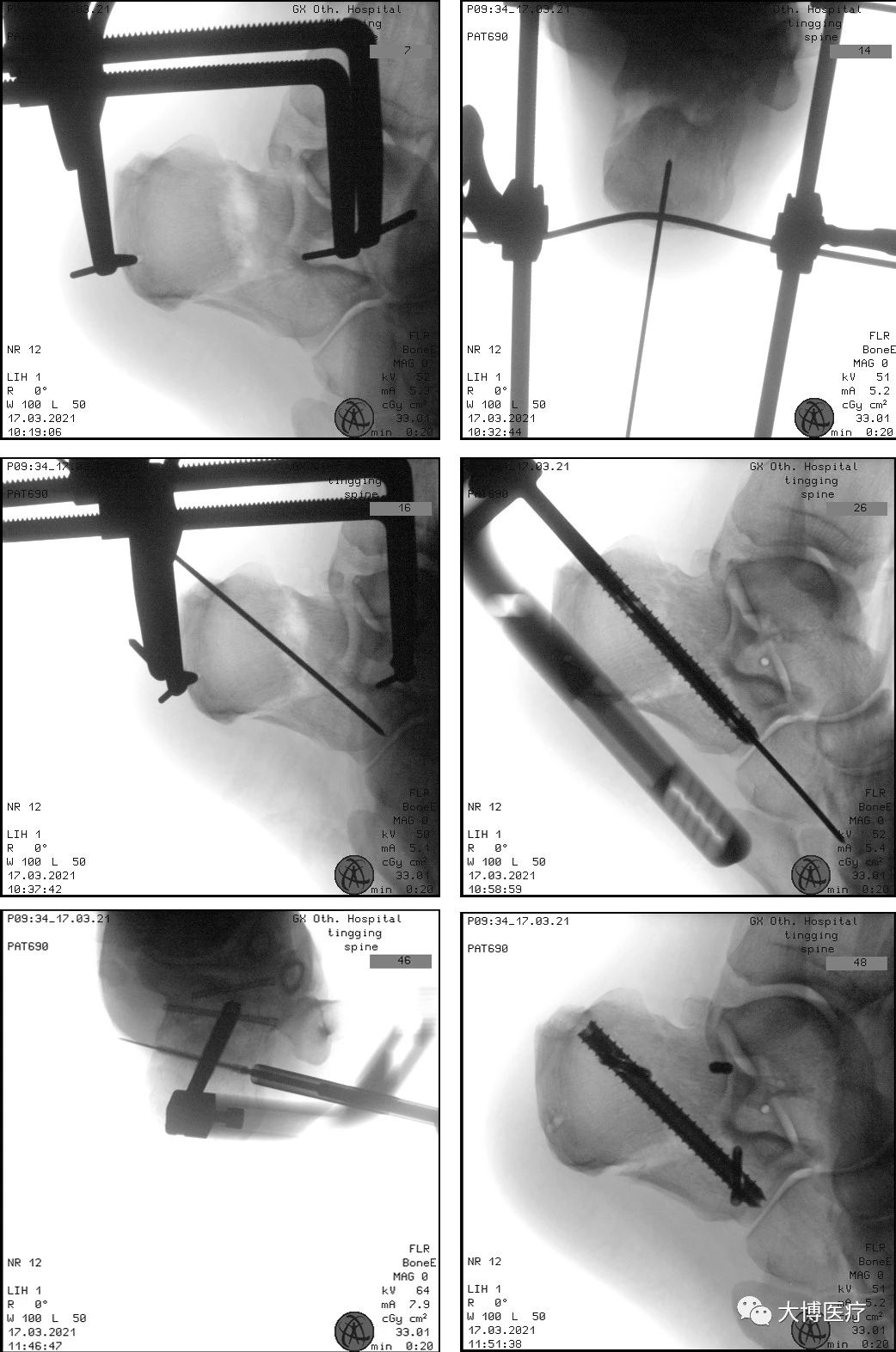 跟骨骨折新手术技术——双医疗跟骨钉系统7 跟骨骨折是足部常见骨折之一,主要由外力创伤导致足跟部骨骼破坏,使其完整性或连续性中断。患者主要表现为剧烈疼痛、肿胀、瘀斑、足跟外翻畸形、扁平足、无法正常行走。.