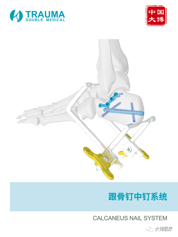 跟骨骨折是足部常见骨折之一，主要由外力创伤导致足跟部骨骼破坏，使其完整性或连续性中断。患者主要表现为剧烈疼痛、肿胀、瘀斑、足跟外翻畸形、扁平足、无法正常行走。.