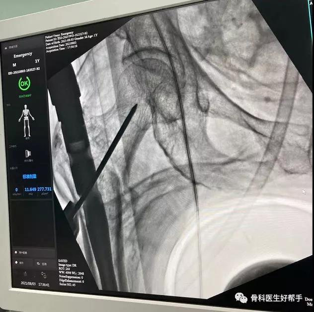 PFBN股骨近端仿生髓内钉临床病例5 股骨转子间骨折是老年人常见的髋部骨折之一。治疗的关键在于坚强固定与早期康复锻炼,这能有效减少因卧床引起的并发症发生,对促进康复具有重要意义。然而,传统骨折内固定系统在治疗过程中失败的情况较为常见。近日,河南省人民医院创伤骨科主任刘涛率先在国际上首次采用并引领了最新理念的PFBN髓内钉固定系统,成功应用于股骨转子间骨折的治疗。病例信息:患者王某,女性,85岁,就诊前1小时因意外摔倒受伤,表现为右髋关节疼痛、活动受限。急诊行右髋关节正位X线检查,以"右侧股骨转子间骨折"收入院进行急诊处理。手术方式:闭合复位PFBN内固定术。术后情况:骨折复位良好,内固定物效果满意。检查影像:术中影像:复位:导针位置:植入:术后影像: