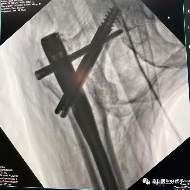 PFBN股骨近端仿生髓内钉临床病例10 股骨转子间骨折是老年人常见的髋部骨折之一。治疗的关键在于坚强固定与早期康复锻炼,这能有效减少因卧床引起的并发症发生,对促进康复具有重要意义。然而,传统骨折内固定系统在治疗过程中失败的情况较为常见。近日,河南省人民医院创伤骨科主任刘涛率先在国际上首次采用并引领了最新理念的PFBN髓内钉固定系统,成功应用于股骨转子间骨折的治疗。病例信息:患者王某,女性,85岁,就诊前1小时因意外摔倒受伤,表现为右髋关节疼痛、活动受限。急诊行右髋关节正位X线检查,以"右侧股骨转子间骨折"收入院进行急诊处理。手术方式:闭合复位PFBN内固定术。术后情况:骨折复位良好,内固定物效果满意。检查影像:术中影像:复位:导针位置:植入:术后影像: