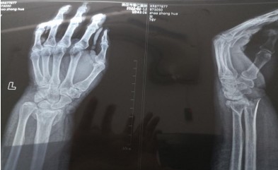 一名53岁女性患者，临床诊断为尺骨远端骨折合并桡骨远端骨折。（桡骨远端接骨板）术前 术中 术后