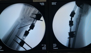 一名53岁女性患者，临床诊断为尺骨远端骨折合并桡骨远端骨折。（桡骨远端接骨板）术前 术中 术后
