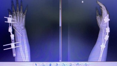 一名53岁女性患者，临床诊断为尺骨远端骨折合并桡骨远端骨折。（桡骨远端接骨板）术前 术中 术后