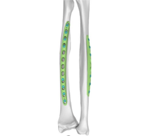 Fracture fixation is a fundamental part of orthopedic trauma care, helping restore bone alignment, maintain fracture stability, and create favorable conditions for bone healing. Among the various fracture fixation methods available today, plate fixation is widely used to treat fractures across different anatomical regions. Within modern plate fixation, locking plates have become an important solution for managing a wide range of fracture patterns.