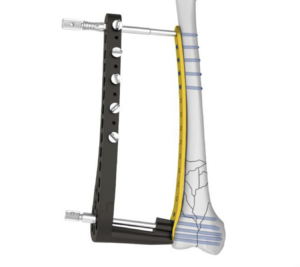 Fracture fixation is a fundamental part of orthopedic trauma care, helping restore bone alignment, maintain fracture stability, and create favorable conditions for bone healing. Among the various fracture fixation methods available today, plate fixation is widely used to treat fractures across different anatomical regions. Within modern plate fixation, locking plates have become an important solution for managing a wide range of fracture patterns.