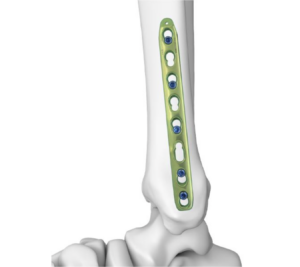 Fracture fixation is a fundamental part of orthopedic trauma care, helping restore bone alignment, maintain fracture stability, and create favorable conditions for bone healing. Among the various fracture fixation methods available today, plate fixation is widely used to treat fractures across different anatomical regions. Within modern plate fixation, locking plates have become an important solution for managing a wide range of fracture patterns.