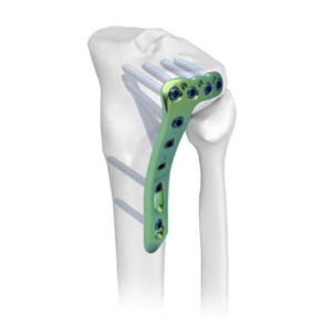 Fracture fixation is a fundamental part of orthopedic trauma care, helping restore bone alignment, maintain fracture stability, and create favorable conditions for bone healing. Among the various fracture fixation methods available today, plate fixation is widely used to treat fractures across different anatomical regions. Within modern plate fixation, locking plates have become an important solution for managing a wide range of fracture patterns.