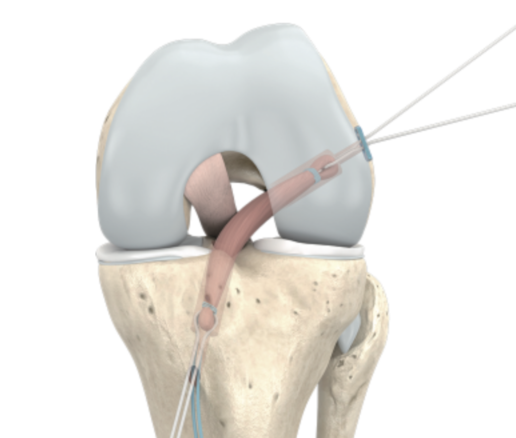ACL graft being passed through femoral and tibial bone tunnels during knee ligament reconstruction surgery