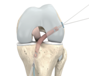 ACL Reconstruction: Graft Fixation Methods, Techniques and Key Considerations 2 ACL graft being passed through femoral and tibial bone tunnels during knee ligament reconstruction surgery